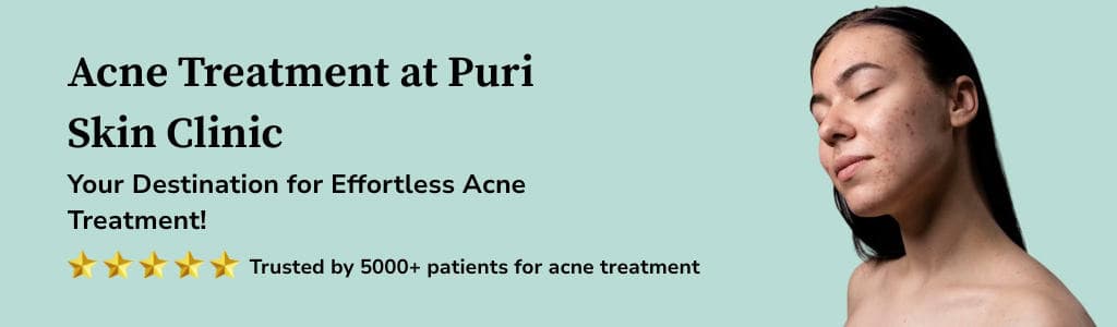Acne Treatment Banner