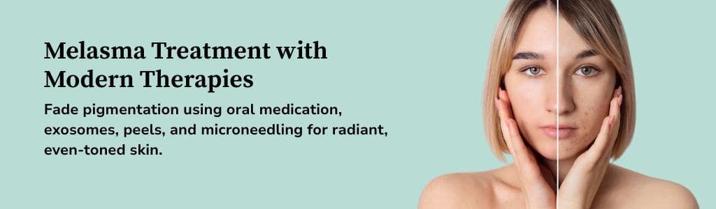 Melasma Treatment Banner