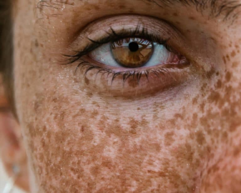 Clinical Melasma Diagnosis