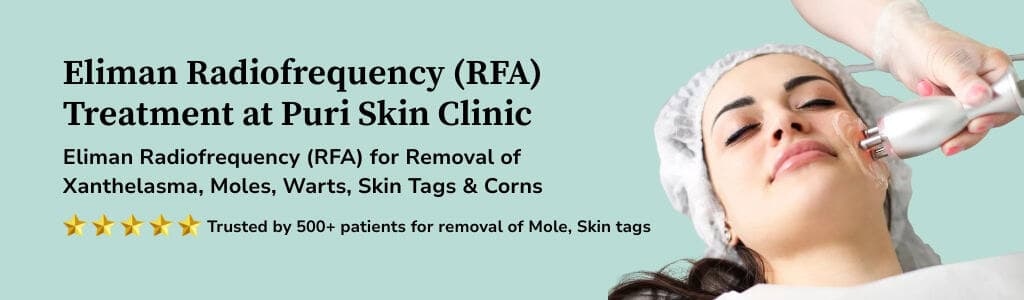 Radio-Frequency Treatment Banner