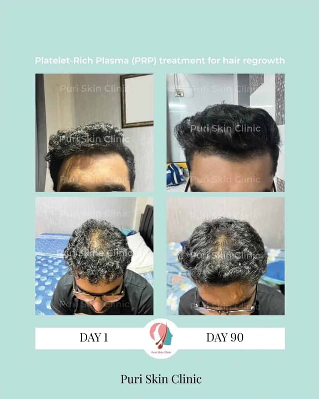 Before and after PRP treatment for hair regrowth at Puri Skin Clinic