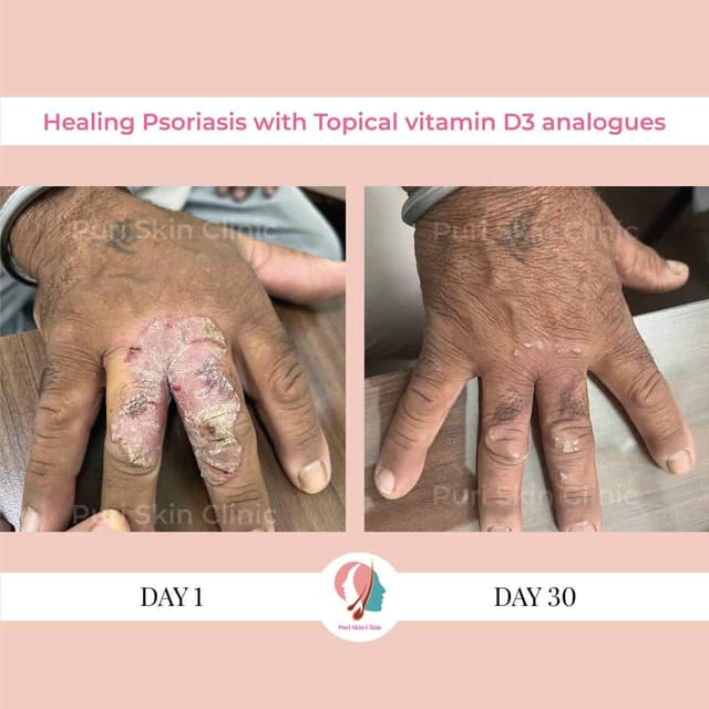 Before and after psoriasis treatment at Puri Skin Clinic
