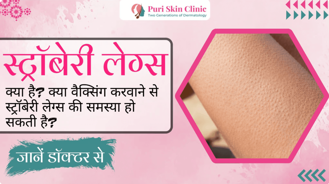 क्या जांघों का कालापन दूर करने के लिए घर पर रखी इन 3 चीजों का इस्तेमाल किया जा सकता है? डॉक्टर से जाने इसके बारे में!
