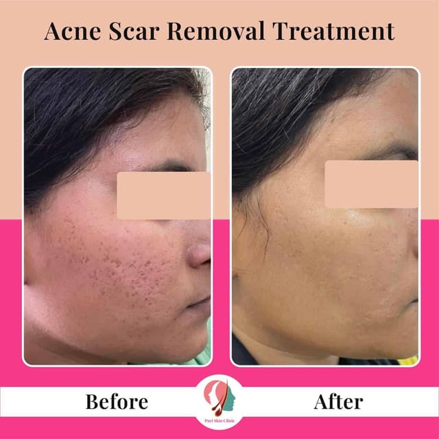 Acne and scar removal at Puri Skin Clinic