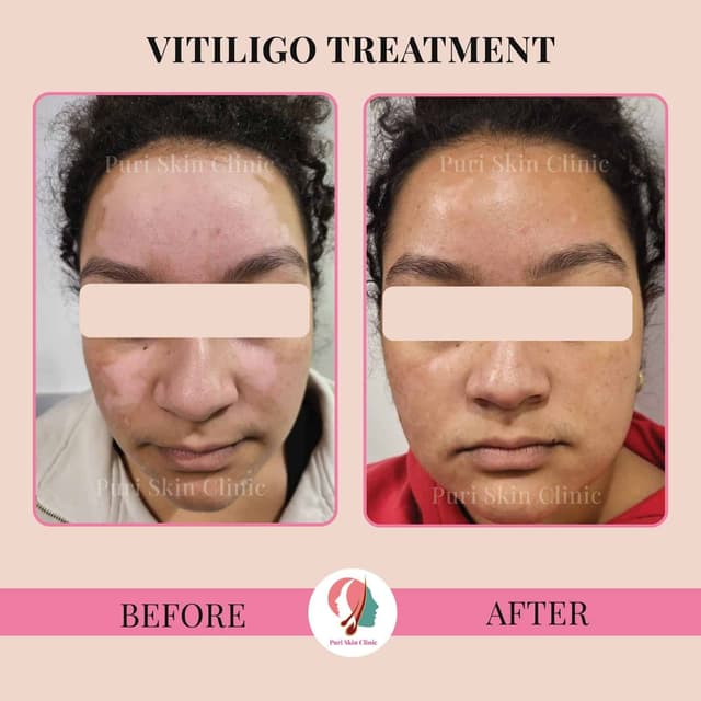 Vitiligo treatment at Puri Skin Clinic