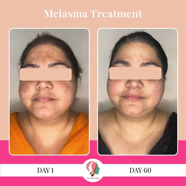 Melasma treatment
