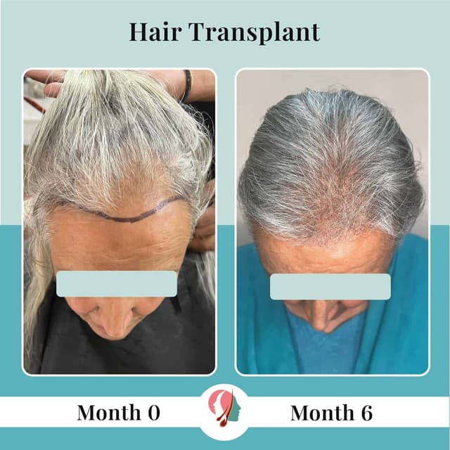 Women hair transplant at Puri skin clinic