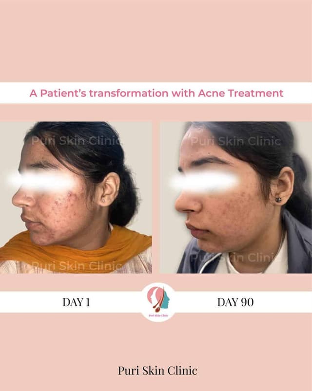 Before and after acne treatment results at Puri Skin Clinic