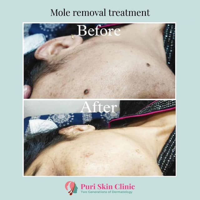 Before and after mole removal treatment at Puri Skin Clinic