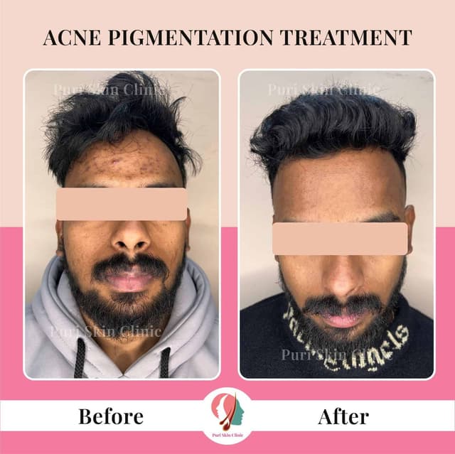 Pigmentation treatment at Puri Skin Clinic