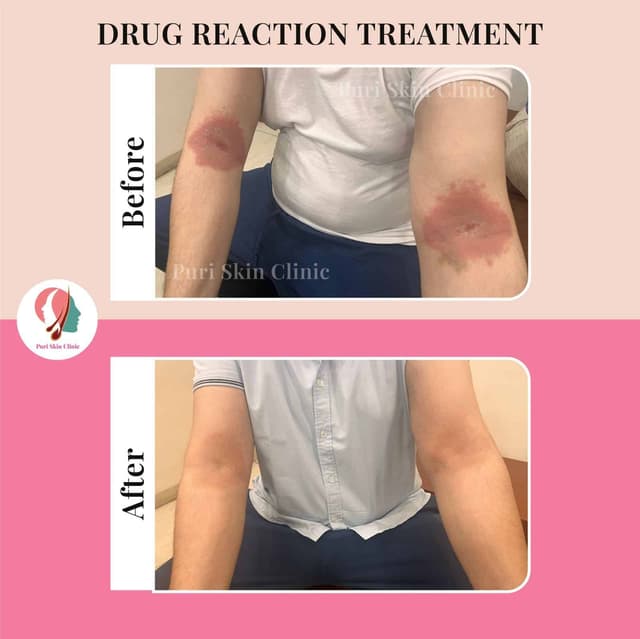 Drug reaction treatment results before and after at puri skin clinic