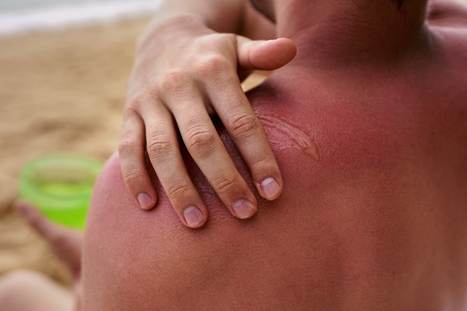 How Does The Excess Summer Heat Damage Your Skin? Get To Know Through This Blog