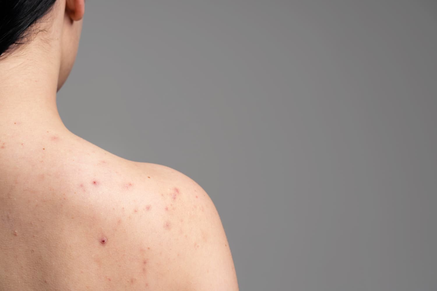 What Are The Tips To Prevent Body Acne? Scroll To Know