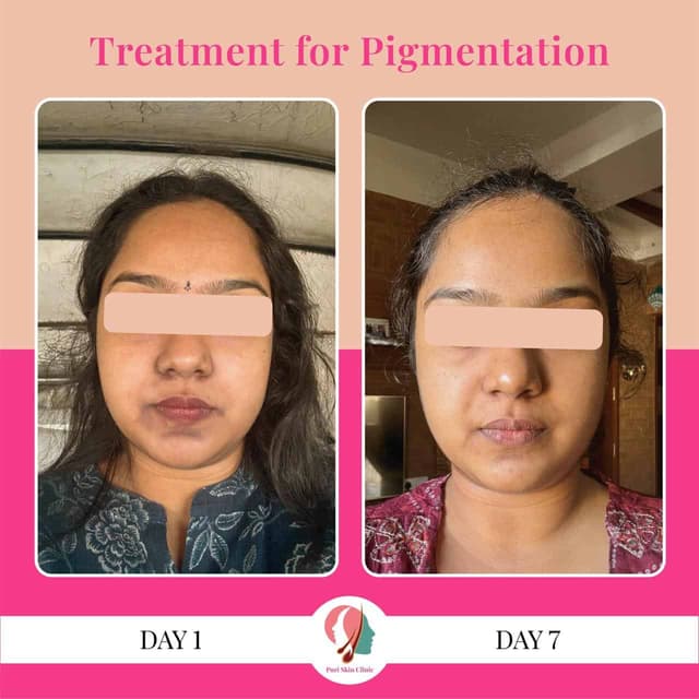 Pigmentation treatment at Puri Skin Clinic