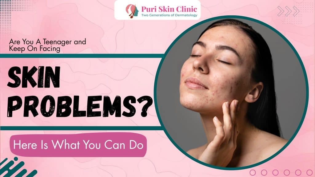 Are You A Teenager and Keep On Facing Skin Problems? Here Is What You Can Do
