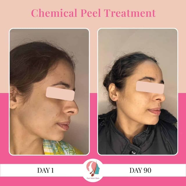 Before and after chemical peel treatment at Puri Skin Clini