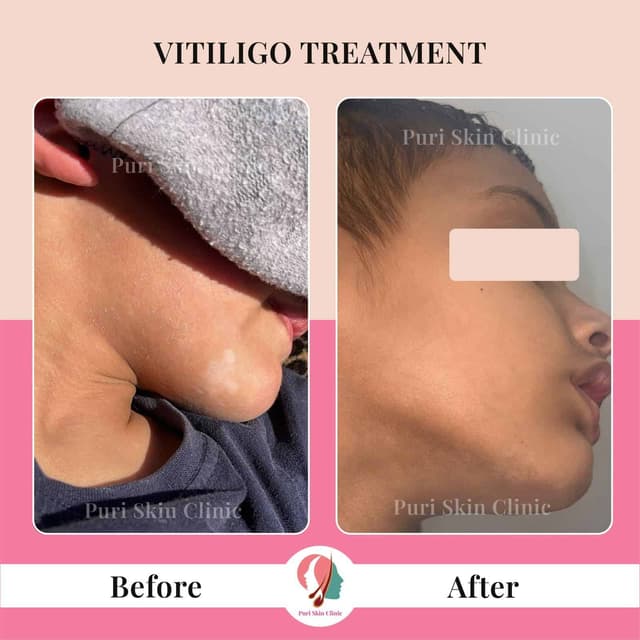 Vitiligo treatment results at Puri skin clinic