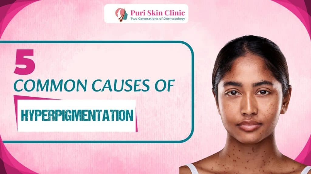 Understanding Hyperpigmentation And Its Natural Remedies