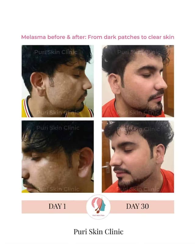 Before and after melasma treatment at Puri Skin Clinic
