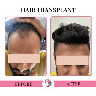 Hair transplant results at Puri Skin Clinic