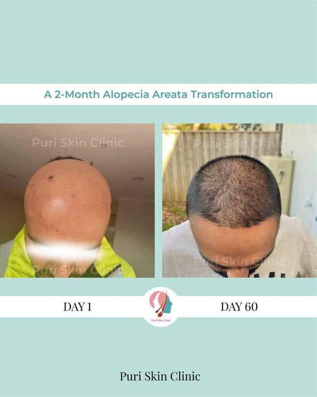 Before and after alopecia areata treatment at Puri Skin Clinic