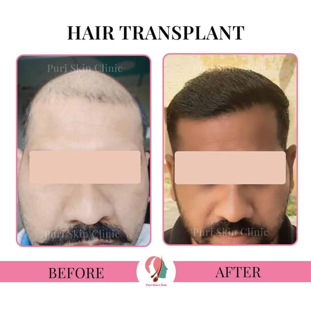 Hair transplant results at Puri Skin Clinic