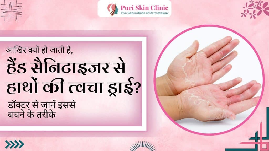 आखिर क्यों हो जाती है, हैंड सैनिटाइजर से हाथों की त्वचा ड्राई? डॉक्टर से जानें इससे बचने के तरीके