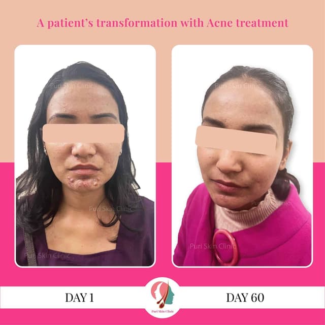 Real life transformation with acne treatment