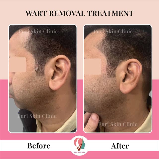 Wart removal treatment results at Puri Skin Clinic