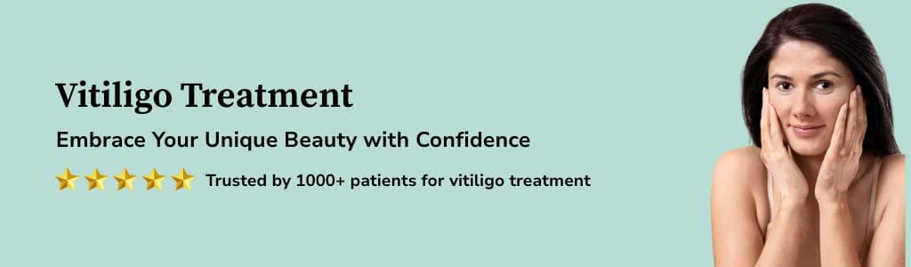 Vitiligo Treatment Banner