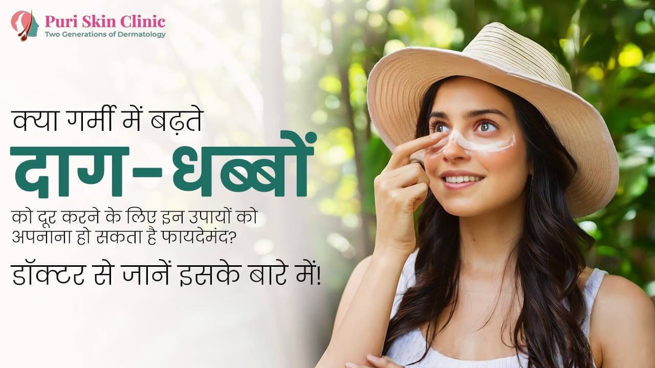 क्या गर्मी में बढ़ते दाग-धब्बों को दूर करने के लिए इन उपायों को अपनाना हो सकता है फायदेमंद? डॉक्टर से जानें इसके बारे में!