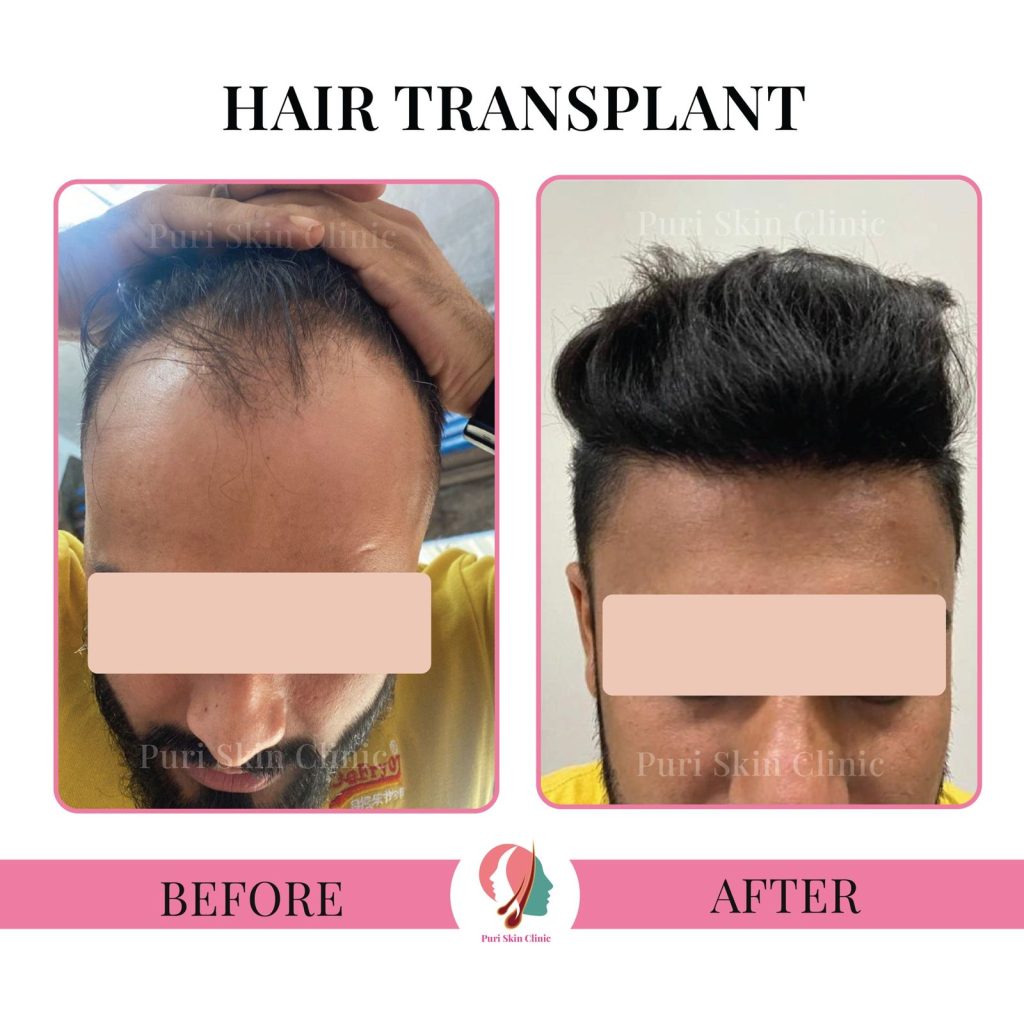 Hair transplant before after results of patient