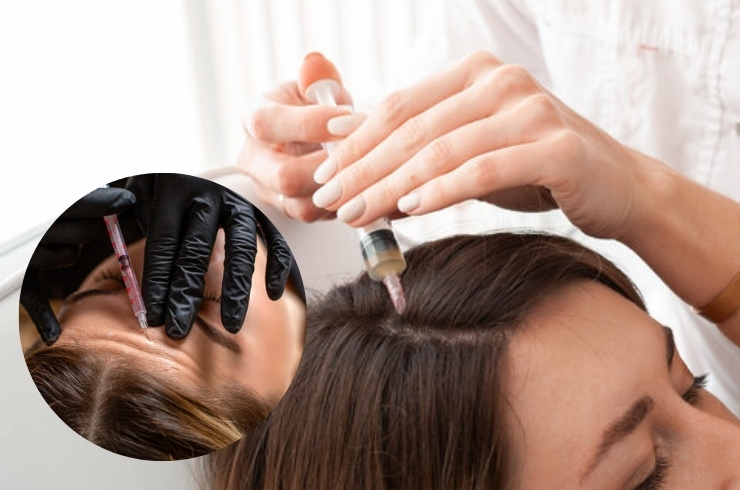 PRP for hair and skin