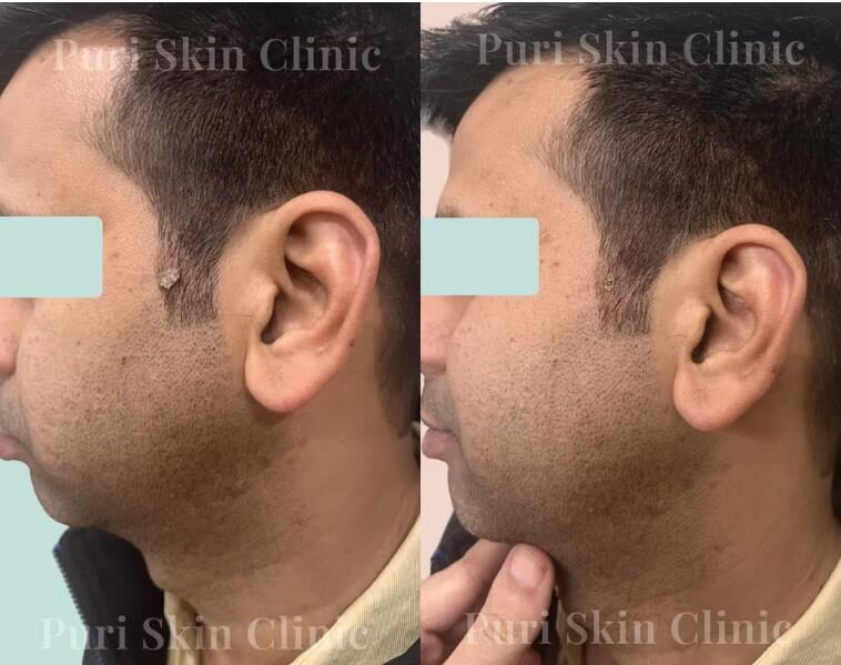 Wart removal result of client