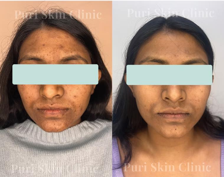 Clients acne treatment results