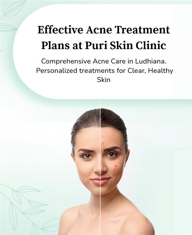 Effective Acne treatment
