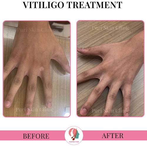 da 0000 hair 3 0003 vitiligo 6